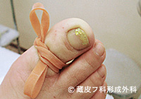 わきが手術方法 1：剪除法＋超音波破壊吸引法