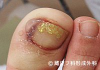 わきが手術方法 6：剪除法＋超音波破壊吸引法