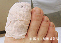 わきが手術方法 7：剪除法＋超音波破壊吸引法