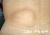脂肪腫（しぼうしゅ）の手術例・手術方法、手順1