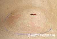 脂肪腫（しぼうしゅ）の手術例・手術方法、手順2