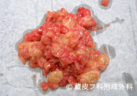 脂肪腫（しぼうしゅ）の手術例・手術方法、手順3