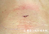 脂肪腫（しぼうしゅ）の手術例・手術方法、手順3