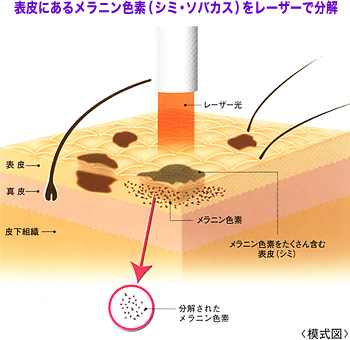 レーザー治療による皮膚の模式図
