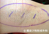 わきが手術方法 1：剪除法＋超音波破壊吸引法