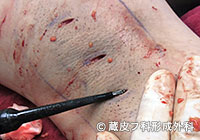 わきが手術方法 4：剪除法＋超音波破壊吸引法