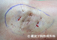 わきが手術方法 5：剪除法＋超音波破壊吸引法