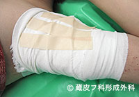 わきが手術方法 6：剪除法＋超音波破壊吸引法