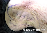 わきが手術方法 8：剪除法＋超音波破壊吸引法