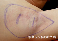 わきが手術方法 1：反転剪除法
