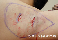 わきが手術方法 2：反転剪除法