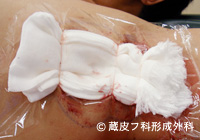 わきが手術方法 4：反転剪除法