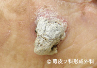 有棘細胞癌（ゆうきょくさいぼうがん）の手術例・手術方法、手順1
