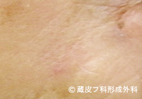 有棘細胞癌（ゆうきょくさいぼうがん）の手術例・手術方法、手順2